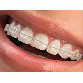 陶瓷自锁半隐形牙套